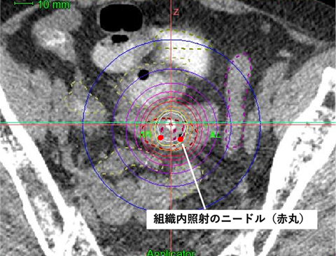ラジオ波治療直後