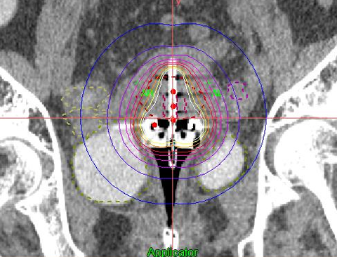 治療後（5年無再発）