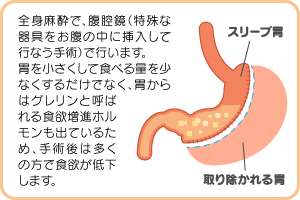 腹腔鏡下スリーブ状胃切除術